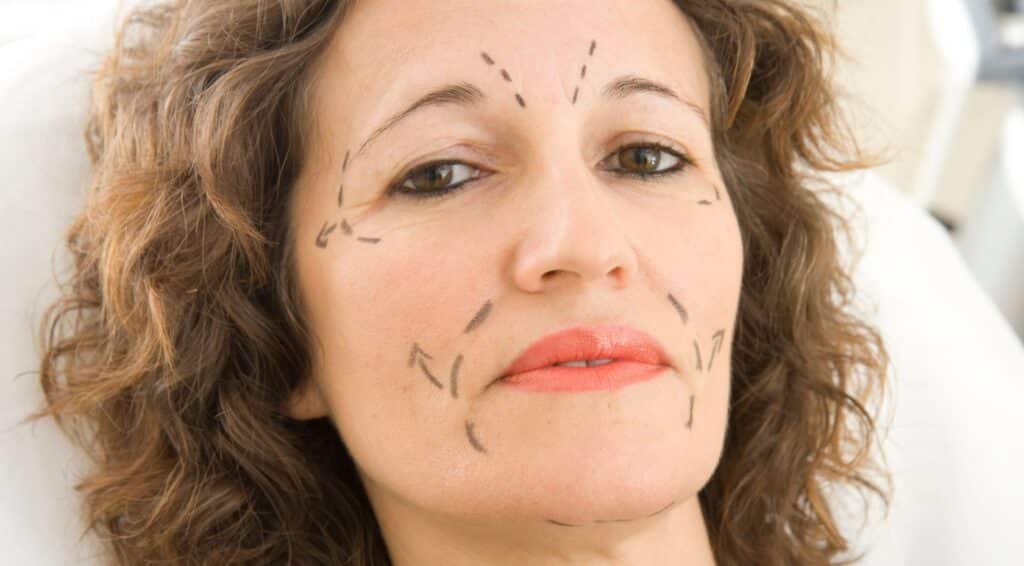 midlife woman with plastic surgery markings